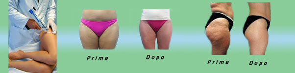 Mesoterapia